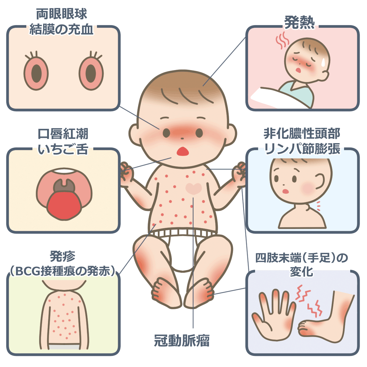 川崎病の原因と最新研究｜なぜ乳幼児に多発？発症の仕組みと初期兆候