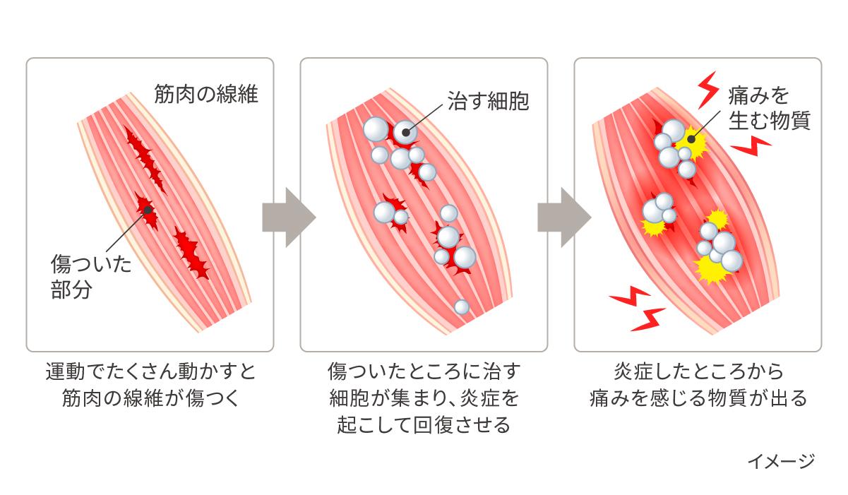 筋肉痛の日にトレは「毒」か「薬」か？2026年の運動生理学が明かす衝撃の事実とプロの回答