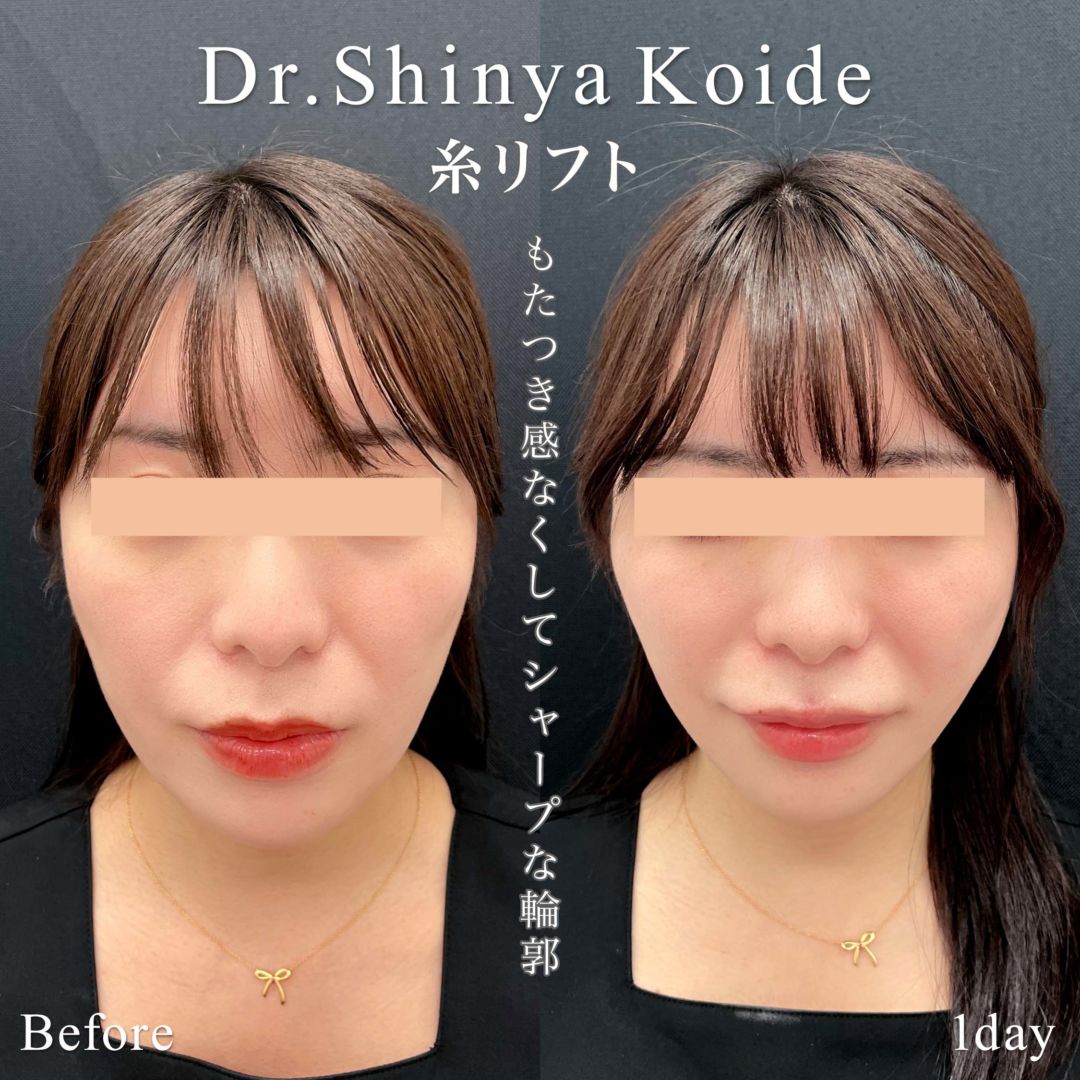 糸リフトの凹みやひきつれは失敗か？治る期間と絶対Ngな対処法を検証