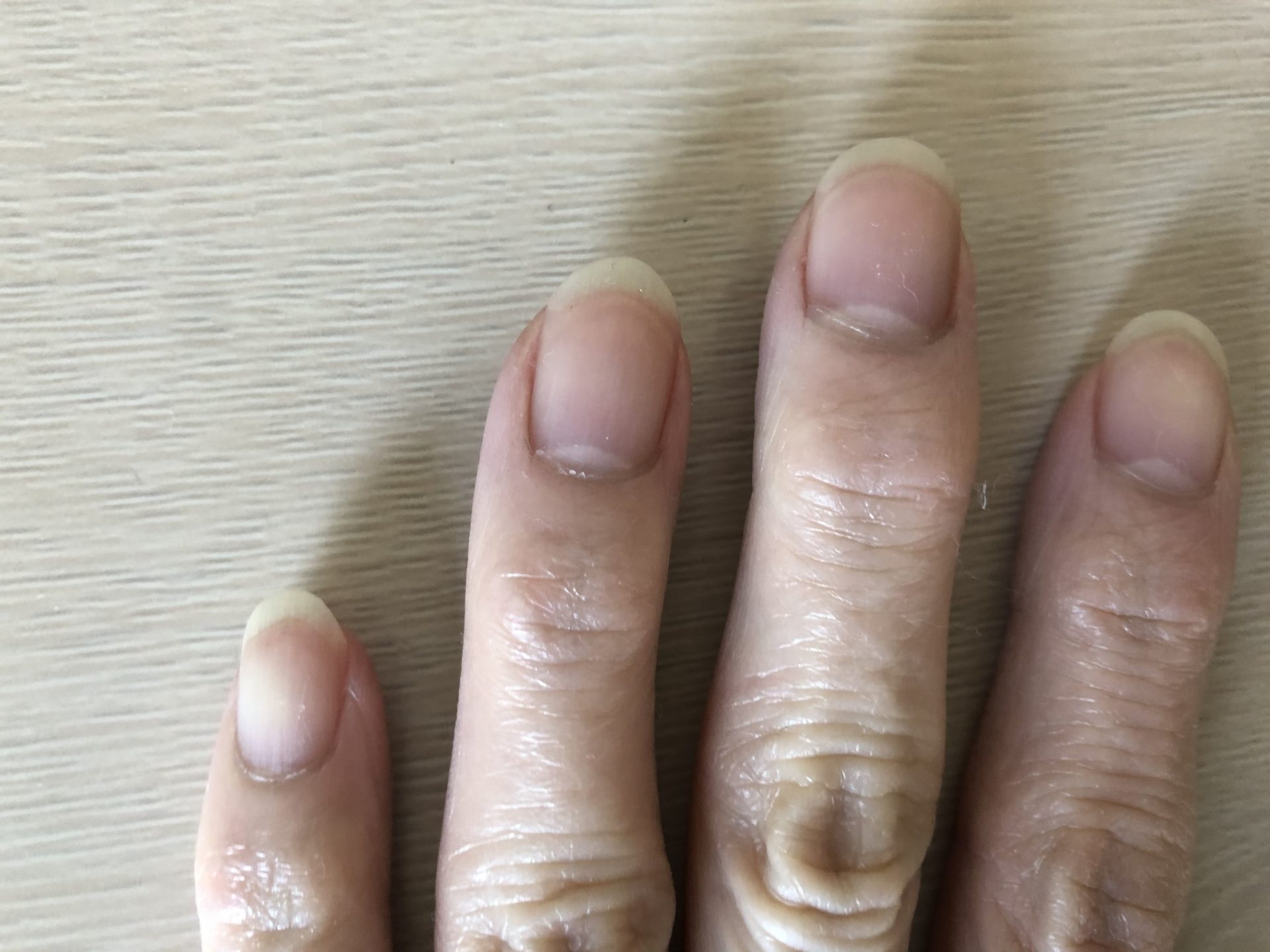 コロナで爪の色が変わる？赤い半月や紫の正体と見逃せない危険サイン
