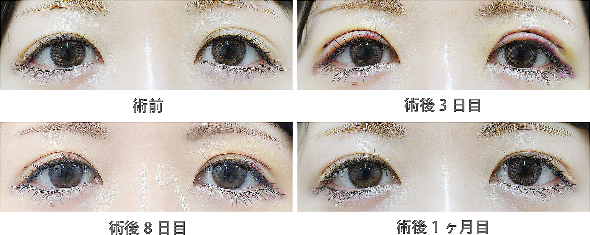 片目の三重まぶたが治らない原因は？即効解消法と定着の真相を徹底解説