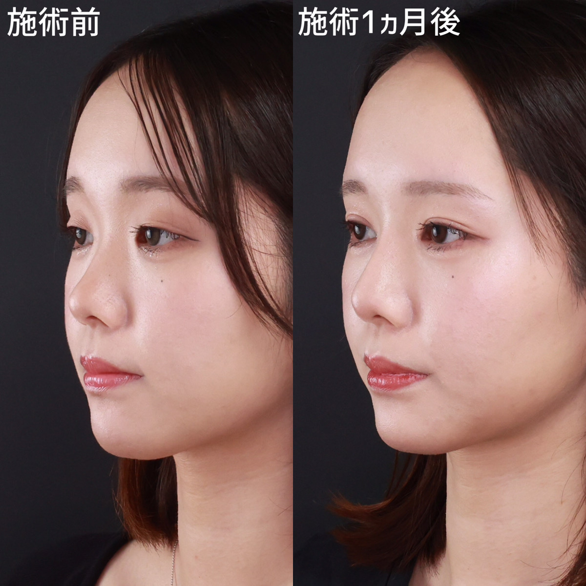 鼻整形した芸能人の真実！公表組と劇的変化を徹底検証【2026】