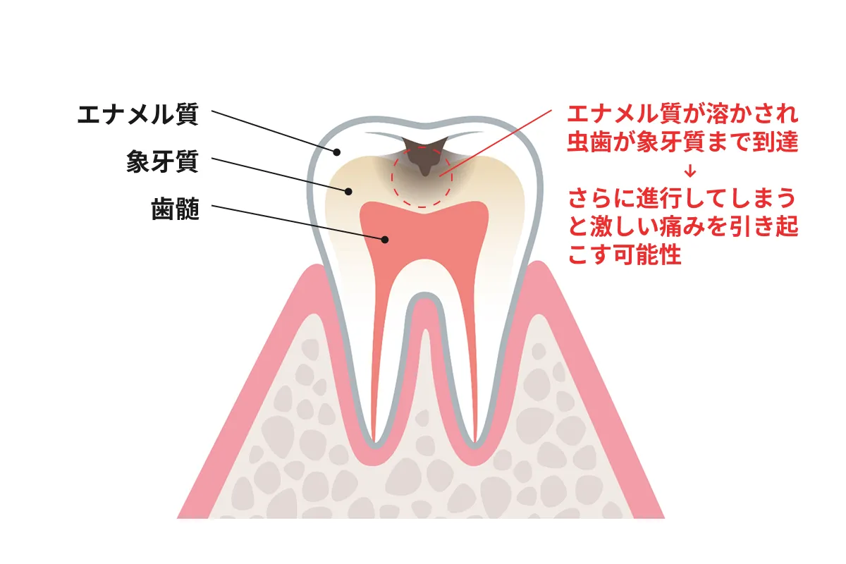 歯がしみる原因と見分け方｜虫歯と知覚過敏の境界線を専門家が徹底検証