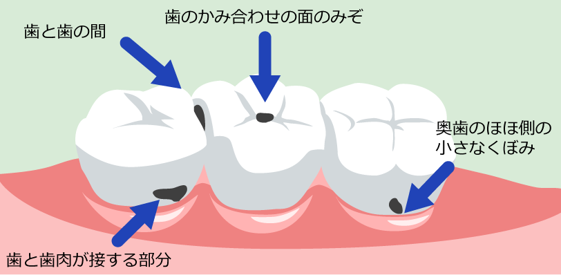 虫歯は自力で治せるのか？削らない最新ケアと手遅れの見極め方