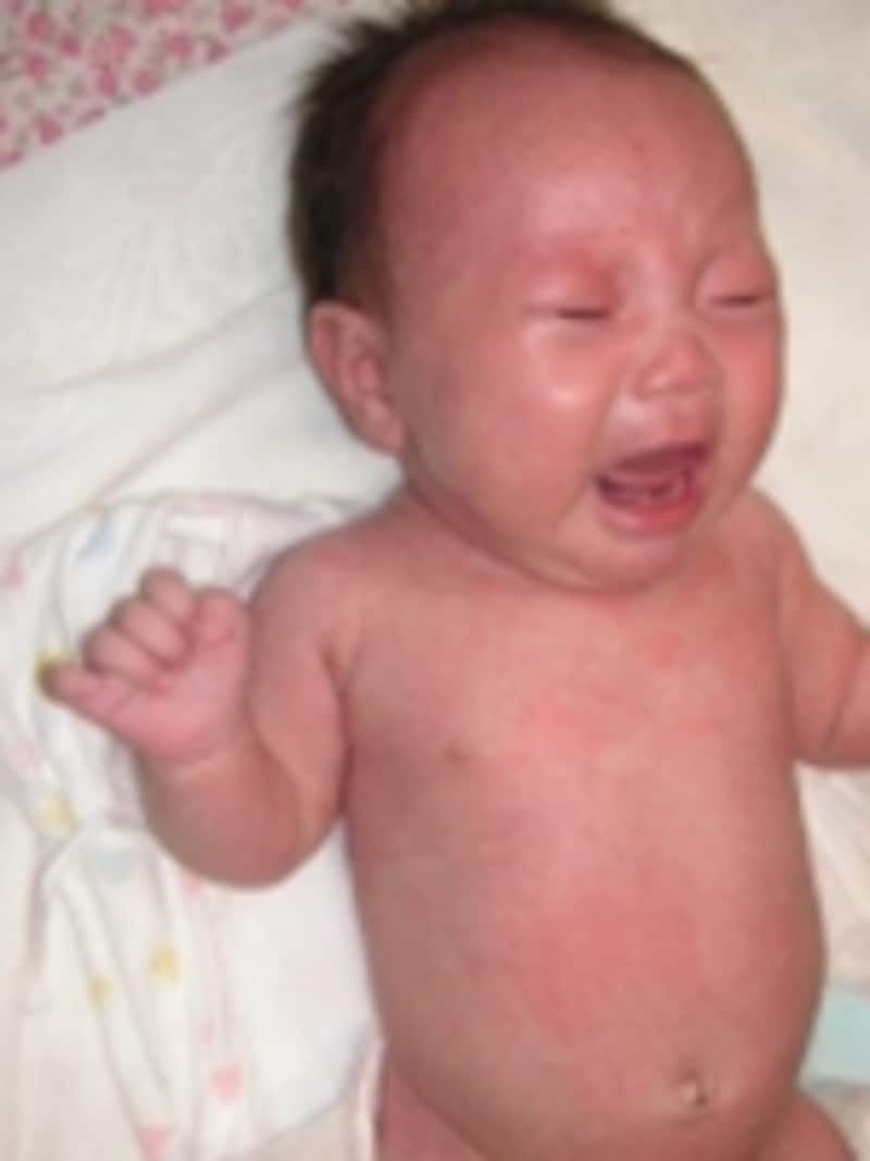 揺さぶられっ子症候群の症状はいつ出る？危険な初期サインと受診基準