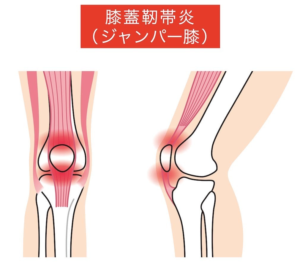 膝をつくと痛い原因は？皿の下や内側の痛みの正体と2026最新対処法