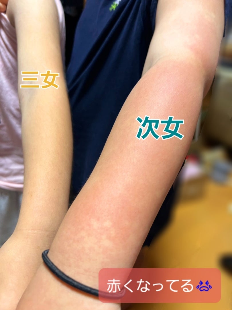 りんご病で病院に行くべきか？頬の赤みと受診目安・感染リスクの真実