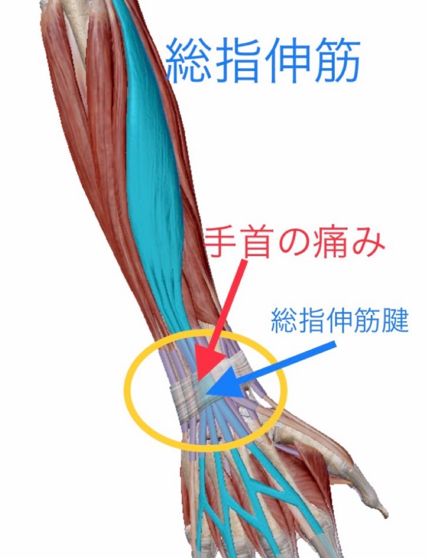 腕立て伏せで手首が痛い原因と治し方｜痛めない手の角度と対策徹底検証