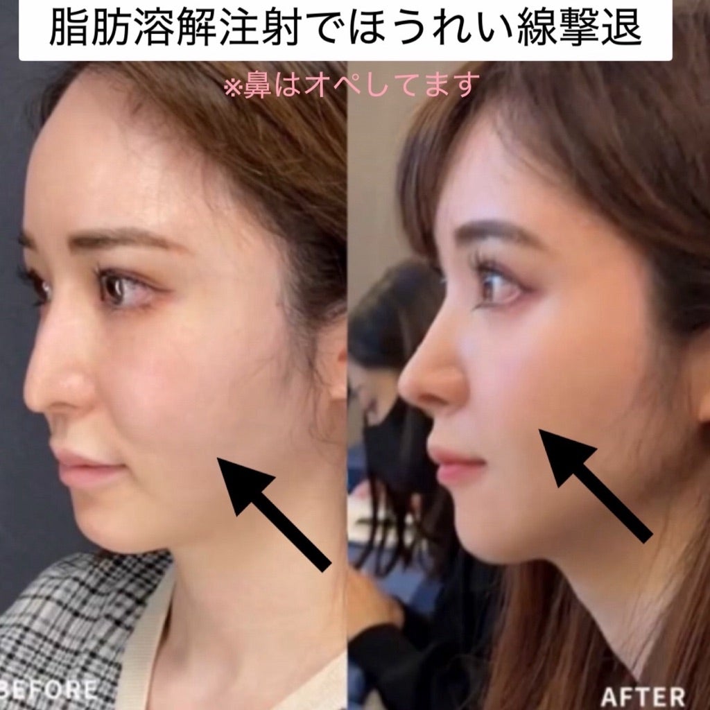 脂肪溶解注射で顔がたるんだ？後悔の真相と皮膚余りの改善策【2026】