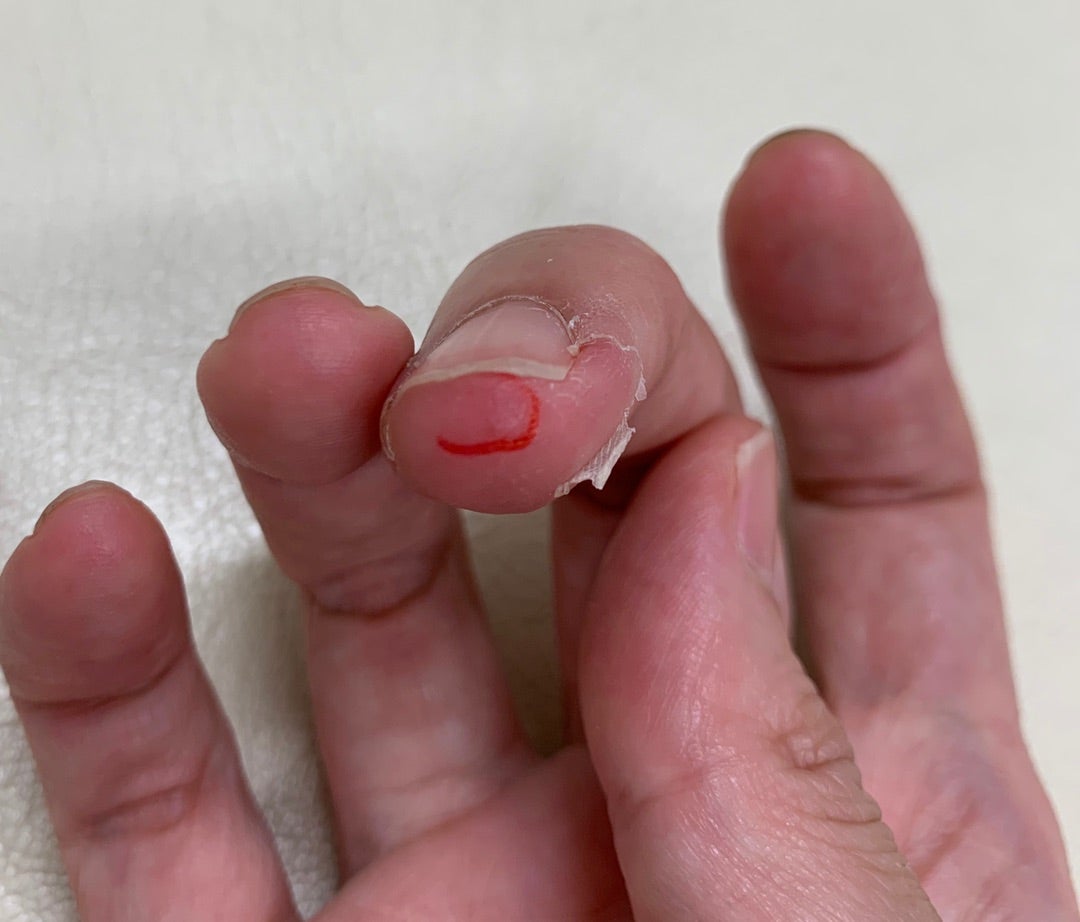 包丁で指を切った時の正しい応急処置｜血が止まらない原因と縫合の基準