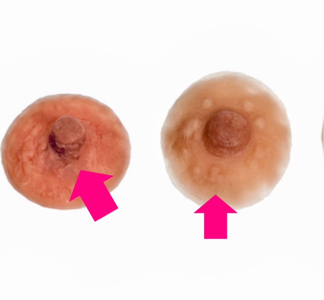 乳首の周りのぶつぶつの正体とは？原因と病気の見分け方を徹底解説