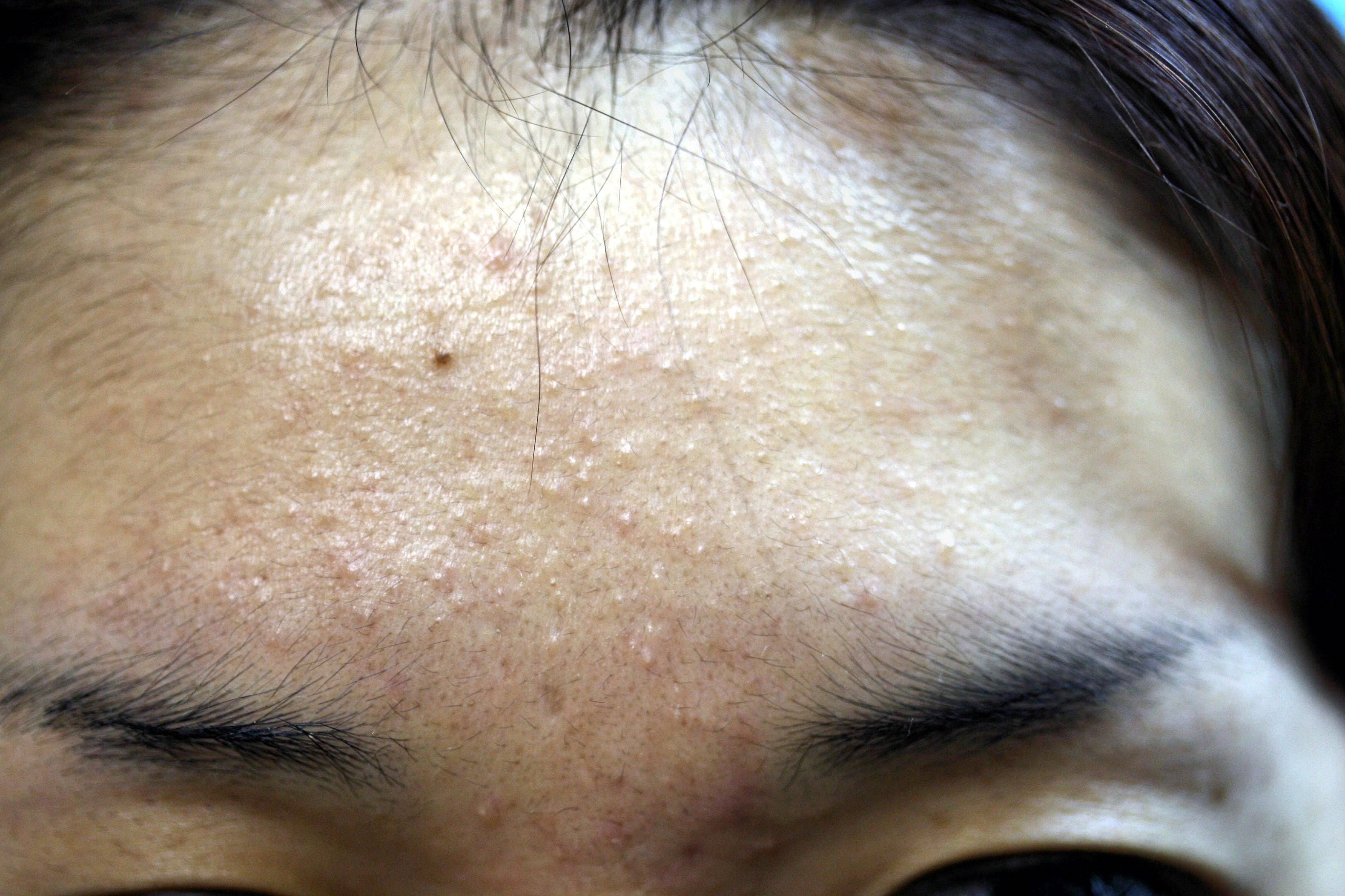 なぜ白ニキビが治らない？稗粒腫の疑いと2026年最新の肌再生術
