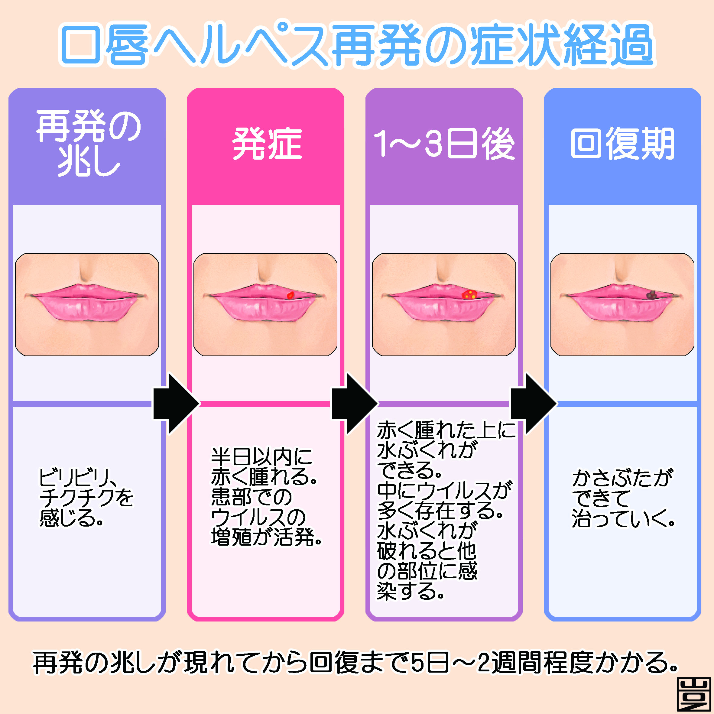 唇ヘルペスはなぜストレスで再発する？原因と初期の治し方を徹底解明