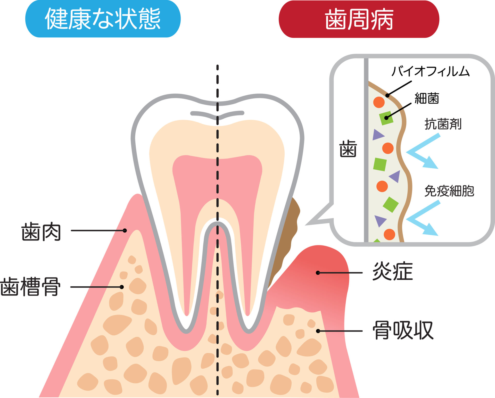 歯を押すと痛い原因とは？放置厳禁のサインと自然治癒の真偽を徹底究明
