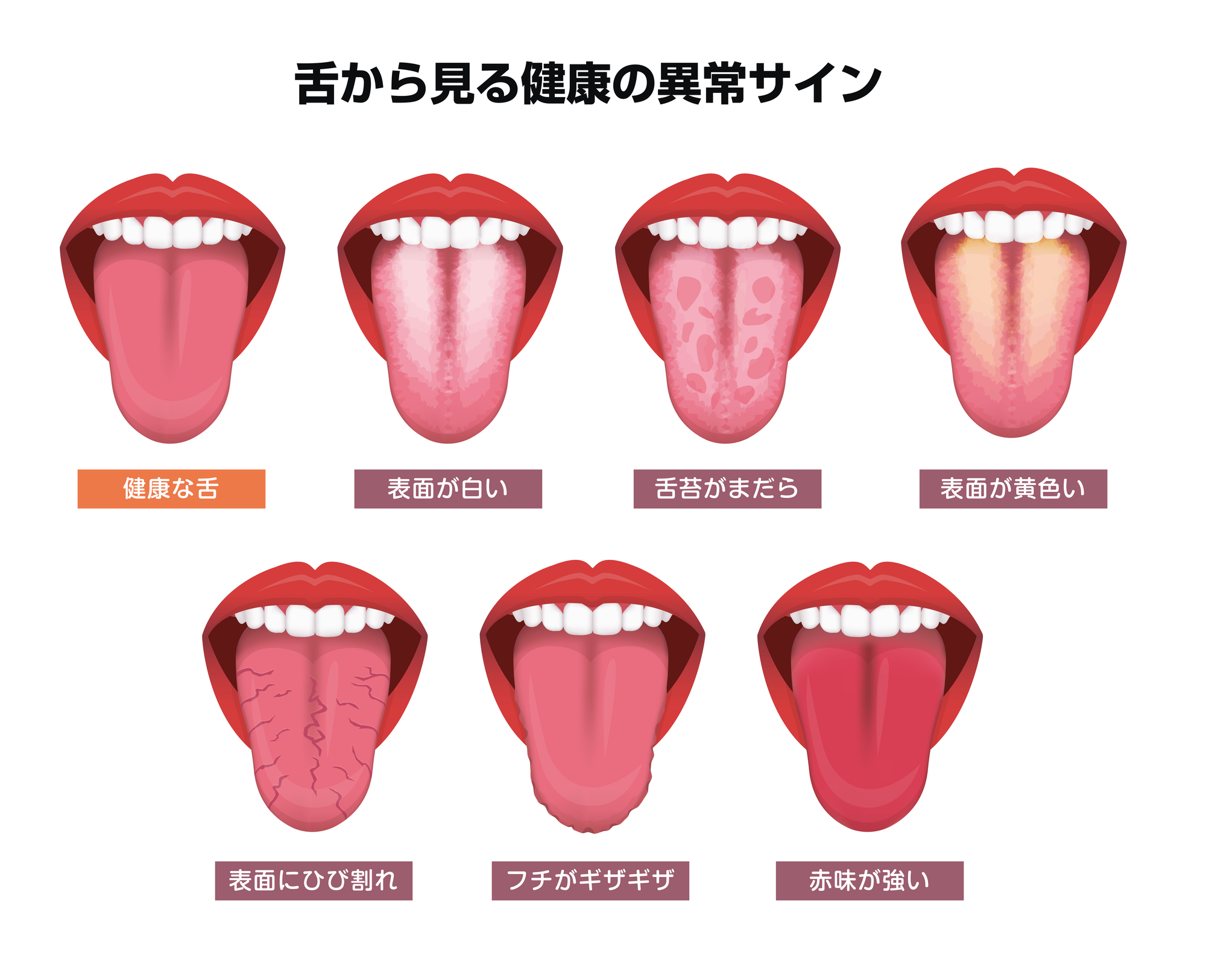ベロが白くなる理由は？病気のサインと正しい舌ケア・受診目安を解説