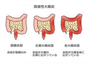 【噂】 潰瘍 性 大腸 炎 芸能人 最新情報まとめ 2026 #709