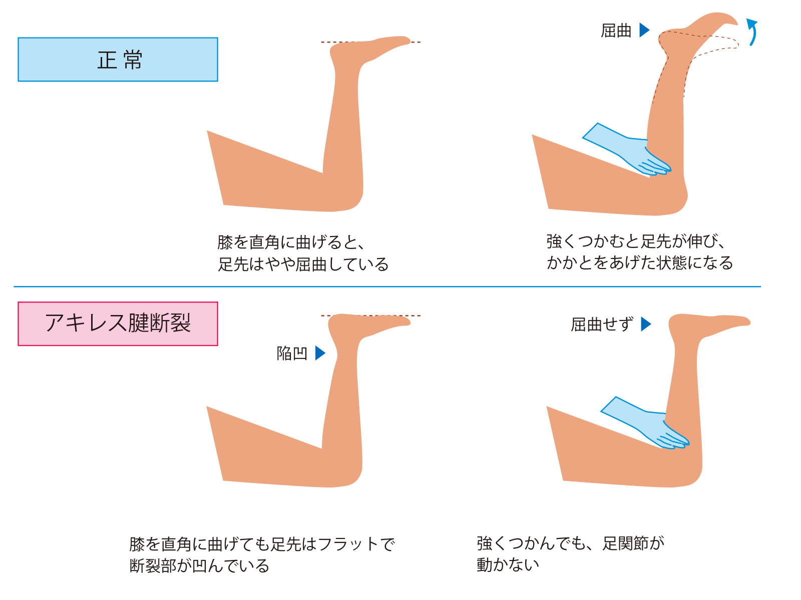 アキレス腱断裂から歩けるまで何日？手術と保存の違いや復帰目安を徹底解説
