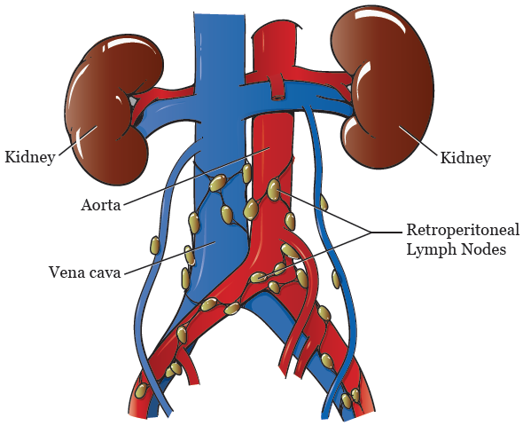 Subcentimeter Lymph Nodes in the Retroperitoneum