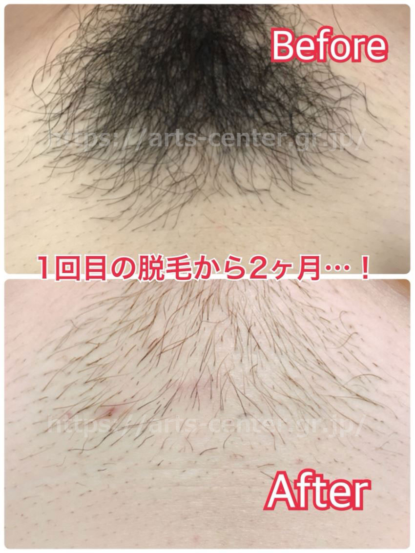 湘南のVio脱毛は痛い？何回でツルツル？後悔しない効果の真相を徹底解説