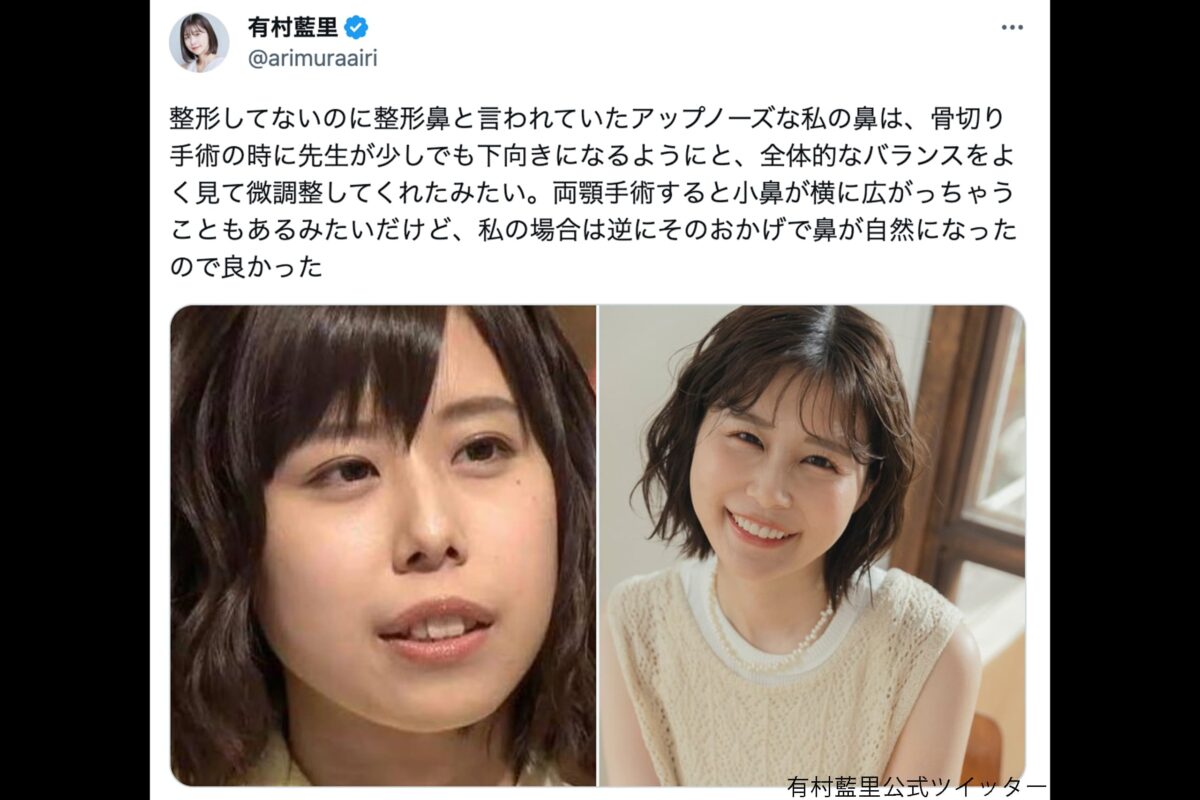 有村藍里の整形告白と現在｜骨切り手術の真実と劇的ビフォーアフター