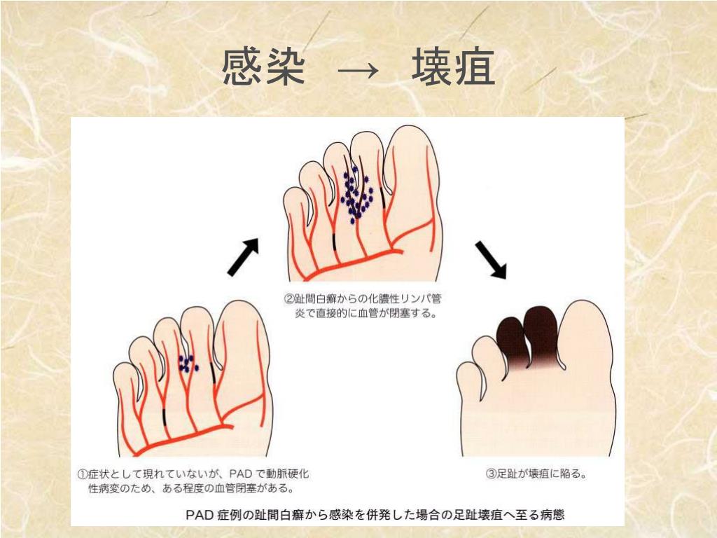 「左足壊死ニキ」とは何者だったのか？衝撃の正体と現在の安否を追う