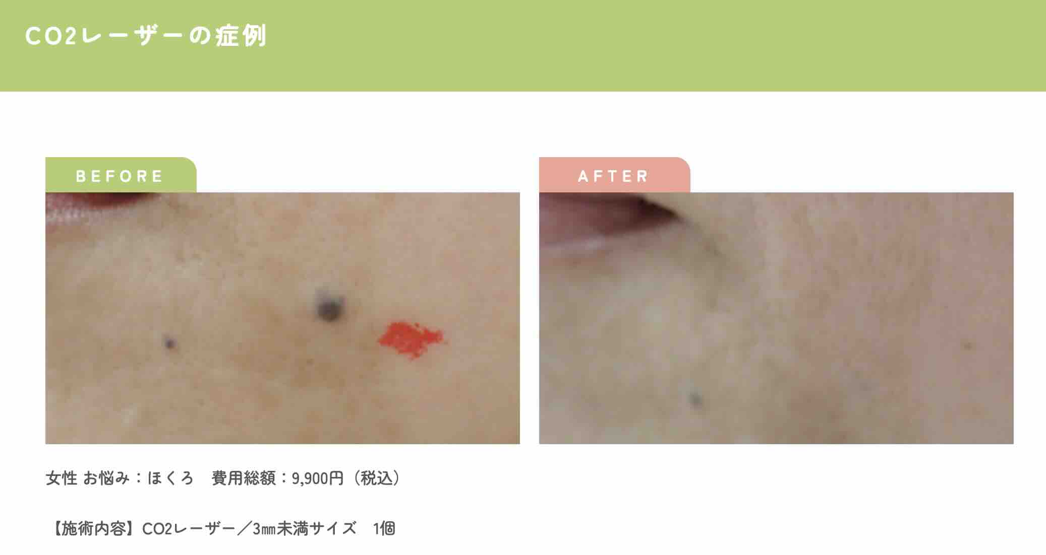 シミとほくろの違いを完全解説！危険な見分け方と最新治療