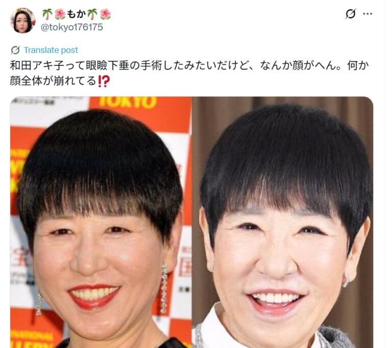 和田アキ子の「顔の変化」に再注目 眼瞼下垂手術から現在までの軌跡と、いま彼女が放つ唯一無二の存在感