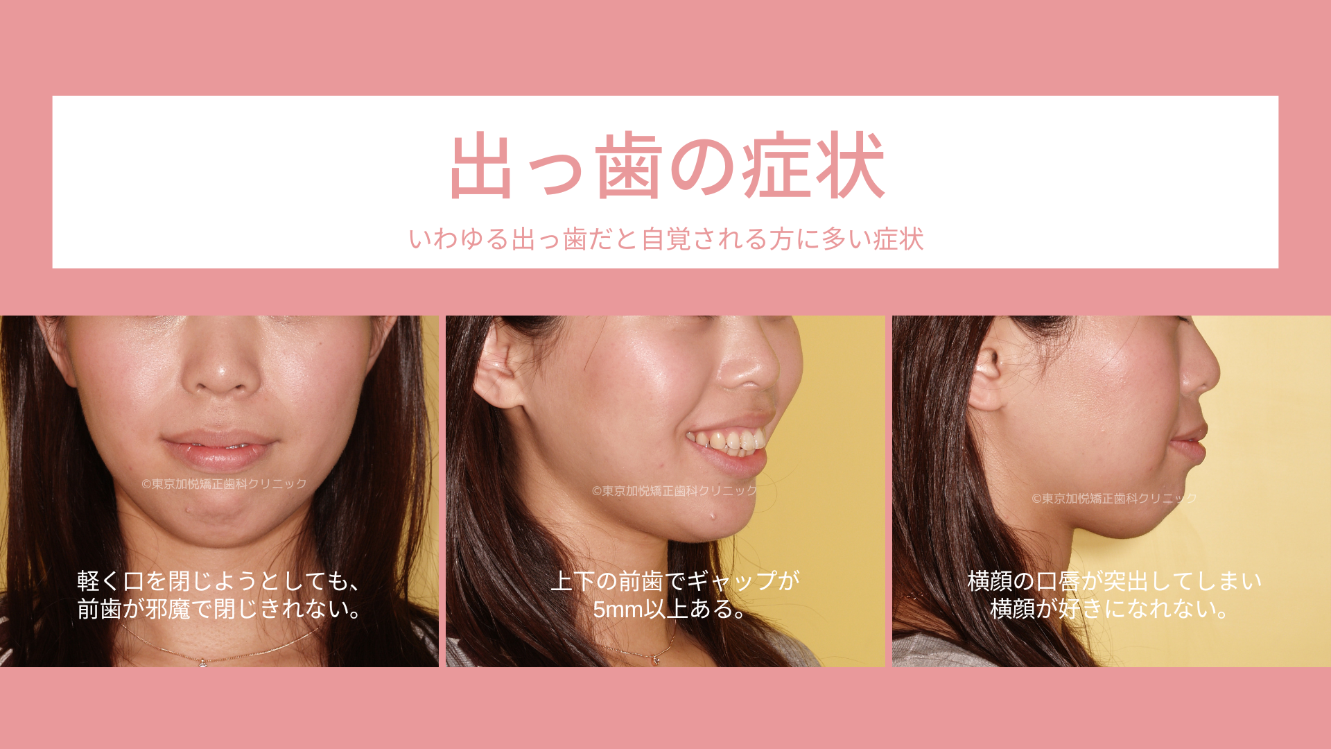 歯列矯正で顔が変わる噂の真相！Eライン劇的変化と後悔の落とし穴