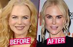 All About Nikole Kidman's Plastic Surgery Procedures: Before and After