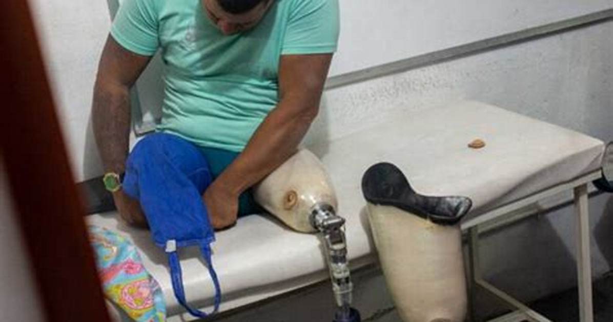 Mason Leg Amputated Surgery: Understanding the Procedure and Recovery