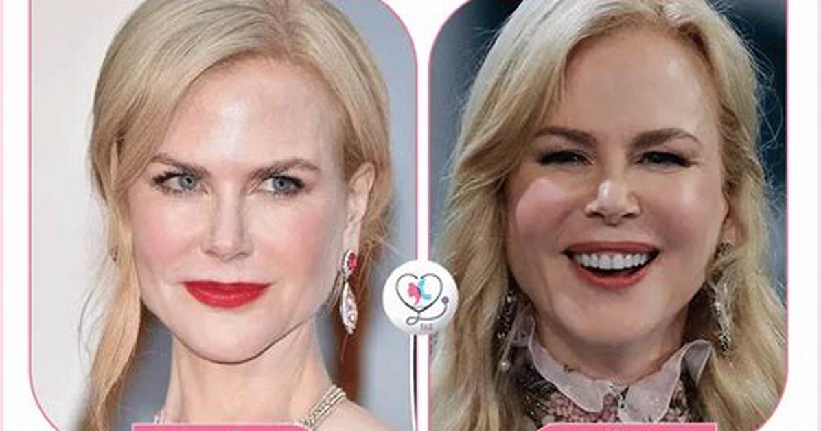 Nicole Kidman Facelift: a Comprehensive Look at Her Transformation and Impact on the Beauty Industry