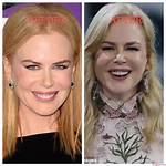 Nicole Kidman's Plastic Surgery Journey in the Northman