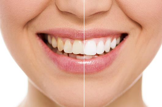 15-Things-to-Consider-Before-you-Whiten-your-Teeth-MainPhoto