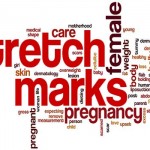 Fine-Lines-How-to-Make-Your-Stretch-Marks-Go-Away-MainPhoto
