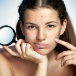 Spot-On-How-to-Get-Rid-of-Blackheads-MainPhoto