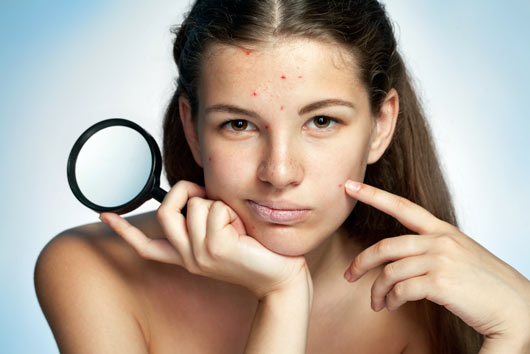 Spot-On-How-to-Get-Rid-of-Blackheads-MainPhoto